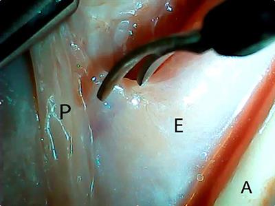 Novel Transgastric Endoluminal Segmental Esophagectomy and Primary Anastomosis Technique: A Hybrid Transgastric Thoracoscopic Esophagectomy for the Treatment of High Grade Dysplasia and Early Esophageal Cancer in a Porcine Ex vivo Model